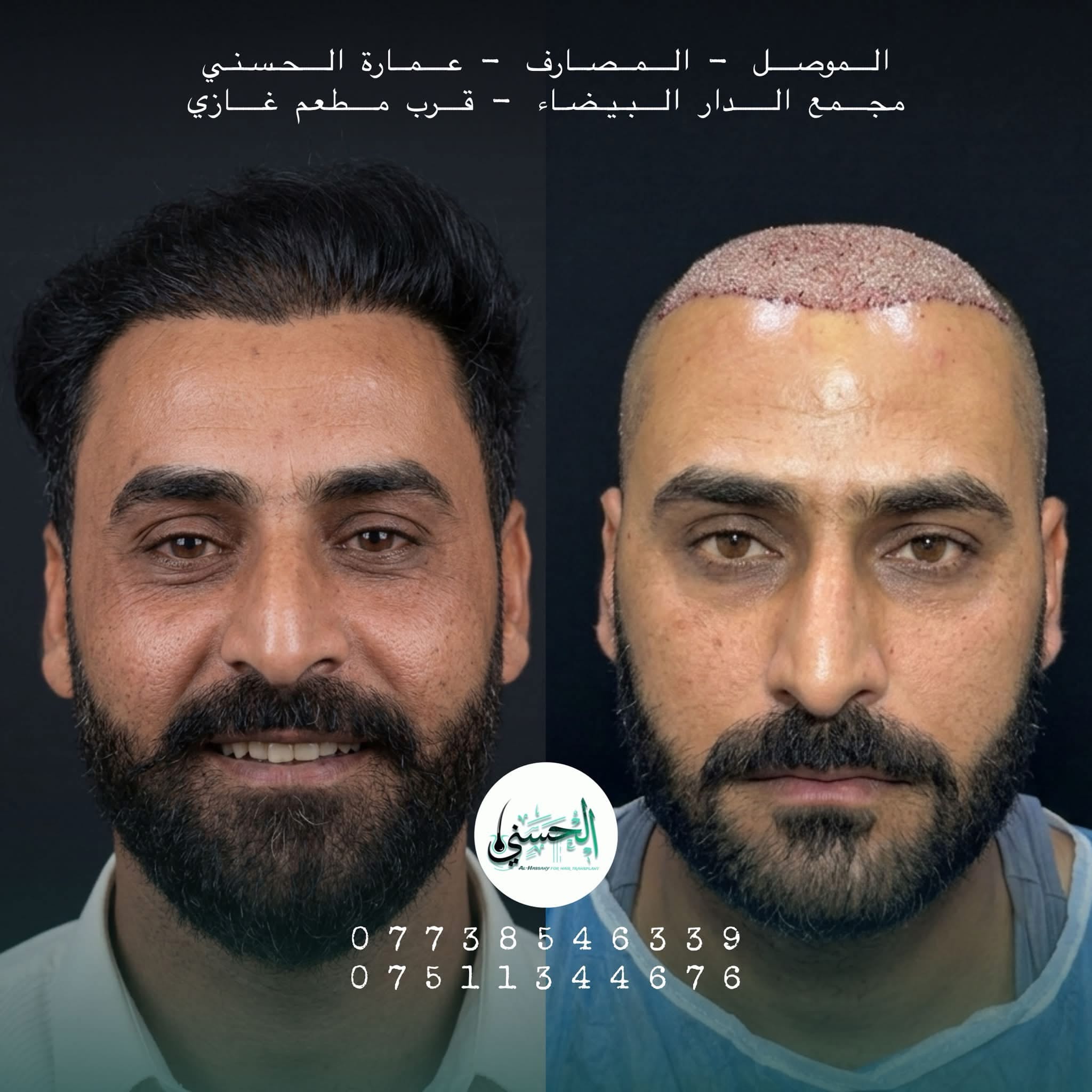 نتيجة زراعة الشعر قبل وبعد — عيادة الحسني الموصل — 01