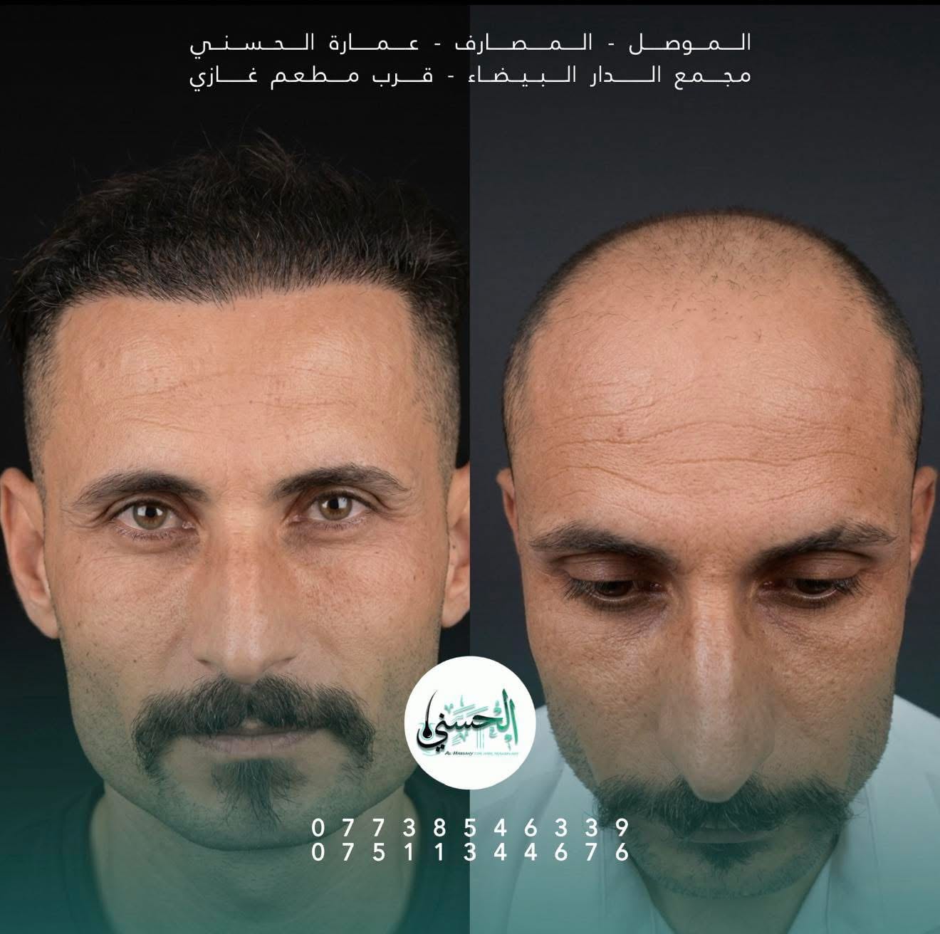 نتيجة زراعة الشعر قبل وبعد — عيادة الحسني الموصل — 03