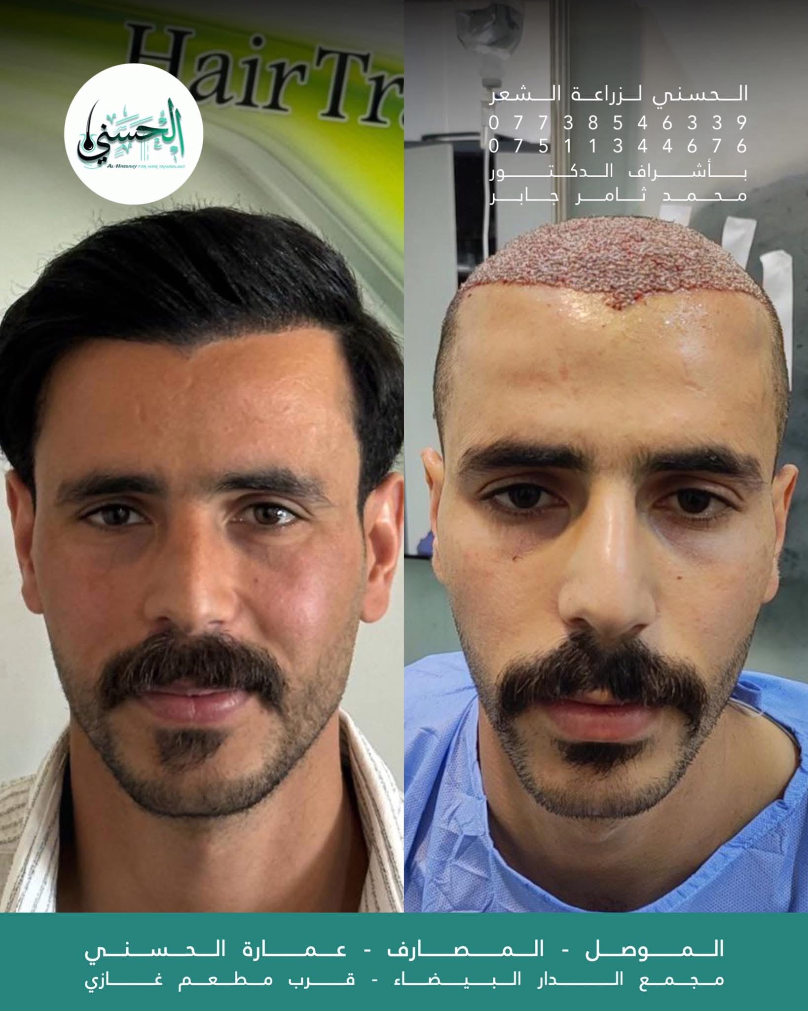 نتيجة زراعة الشعر قبل وبعد — عيادة الحسني الموصل — 08