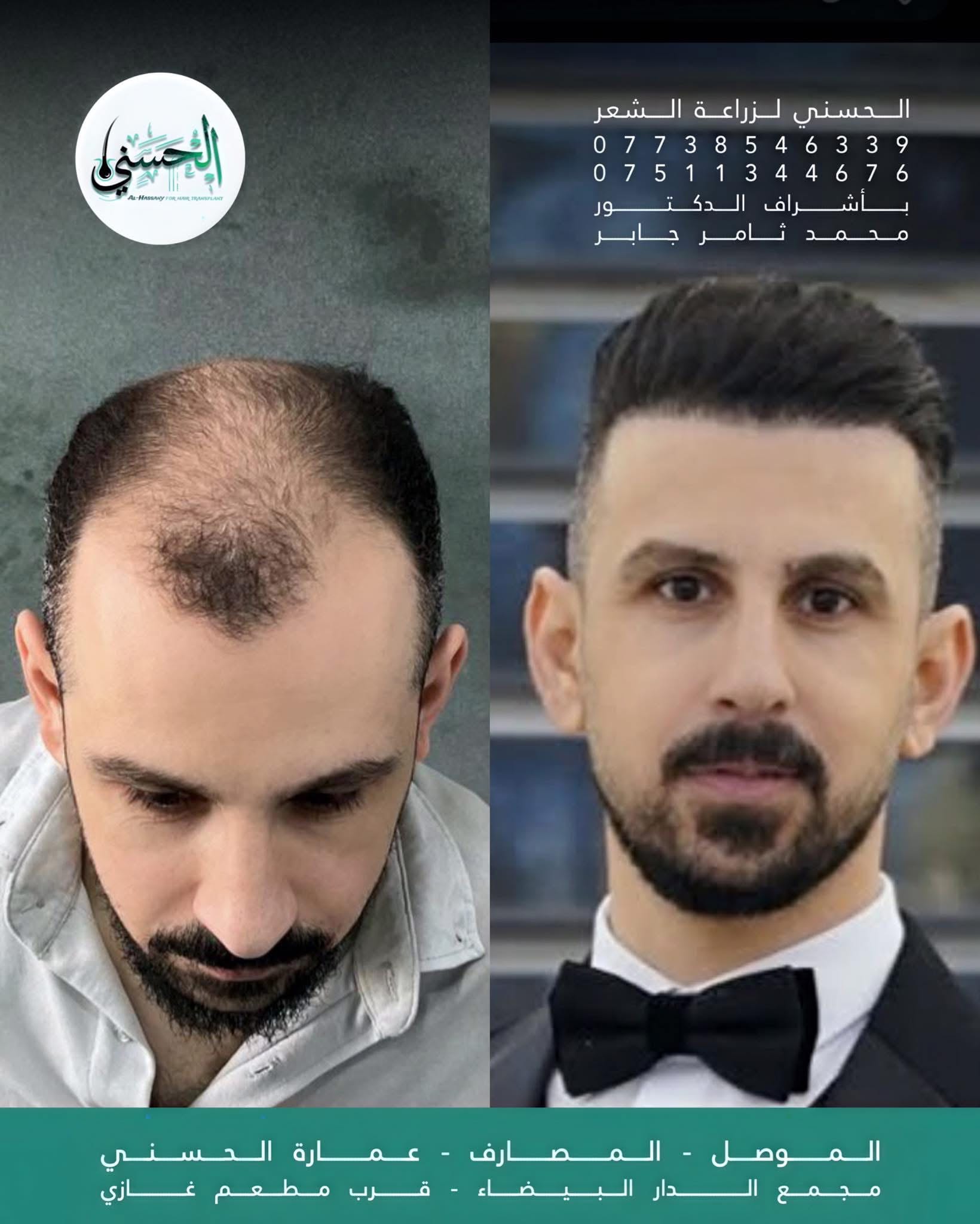 نتيجة زراعة الشعر قبل وبعد — عيادة الحسني الموصل — 09