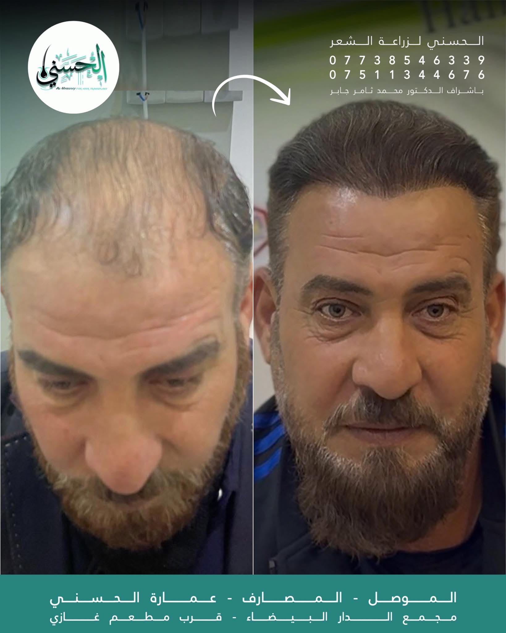 نتيجة زراعة الشعر قبل وبعد — عيادة الحسني الموصل — 11
