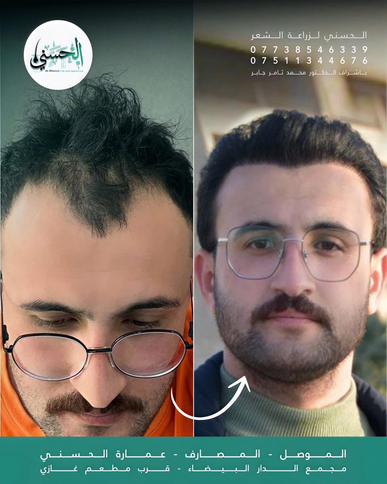 نتيجة زراعة الشعر قبل وبعد — عيادة الحسني الموصل — 13